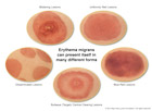 Erythema migrans Rash Types shows the 5 forms of rash caused by Lyme disease, blistering lesions, uniformly red lesions, disseminated lesions, blue-red lesions, bullseye/target lesions. This medical illustration was created in Adobe Photoshop for Bay Area Lyme Foundation