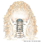 Cervical Spinal fusion illustration