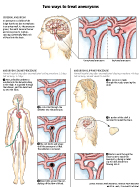 Two ways to treat brain aneurysms- process described in steps